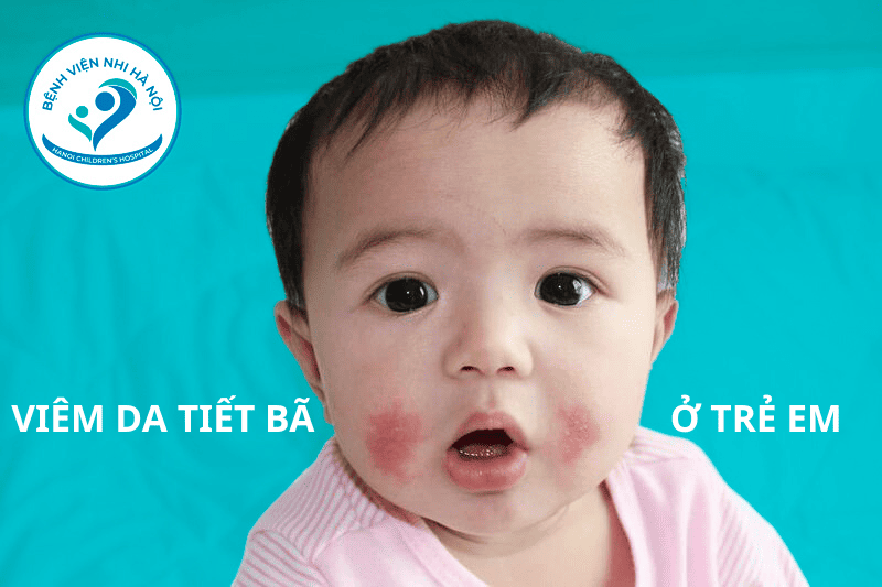 BỆNH VIÊM DA TIẾT BÃ: Nguyên nhân, triệu chứng và 5 cách điều trị