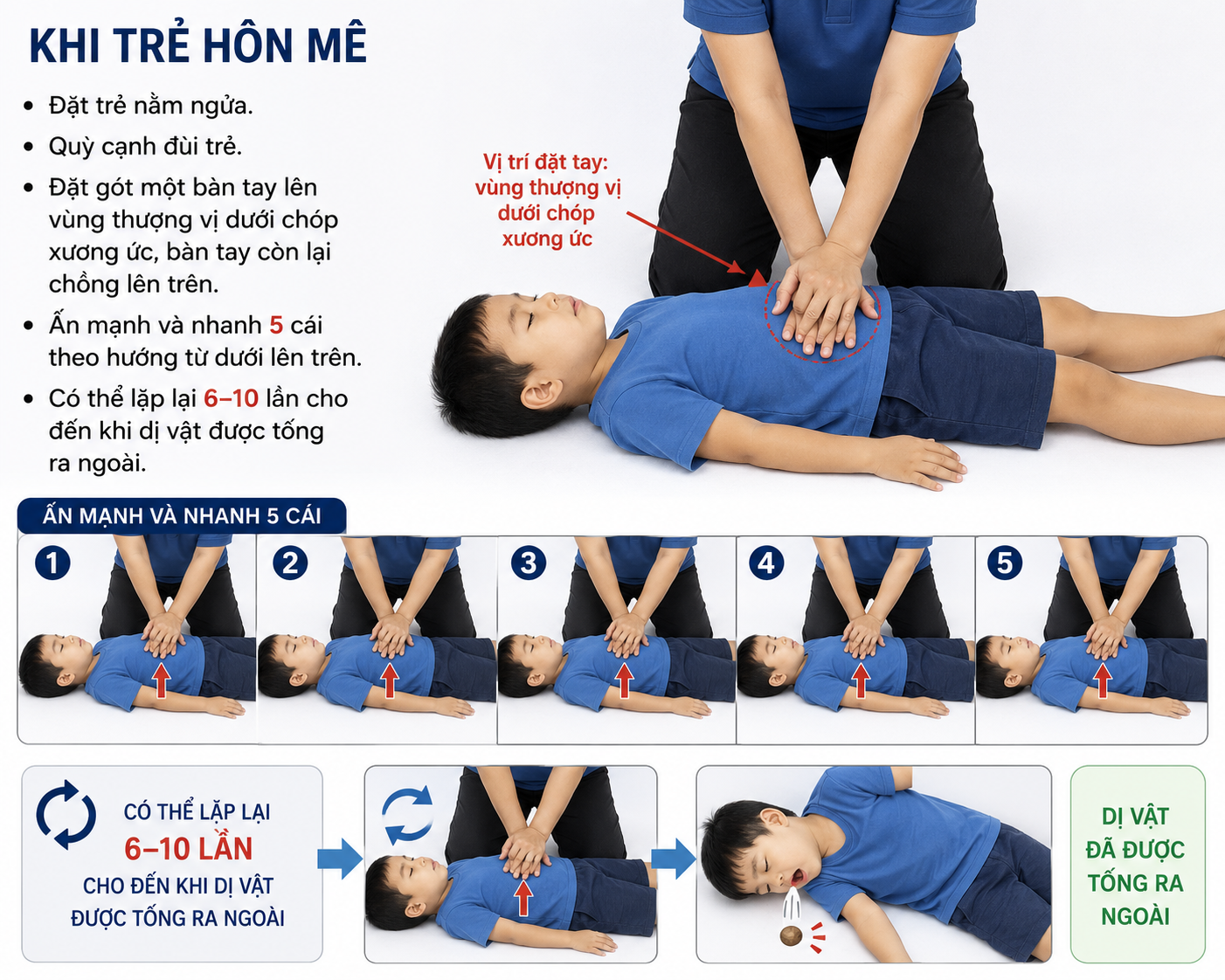 Khi trẻ hôn mê Đặt trẻ nằm ngửa. Quỳ cạnh đùi trẻ. Đặt gót một bàn tay lên vùng thượng vị dưới chóp xương ức, bàn tay còn lại chồng lên trên. Ấn mạnh và nhanh 5 cái theo hướng từ dưới lên trên. Có thể lặp lại 6–10 lần cho đến khi dị vật được tống ra ngoài.