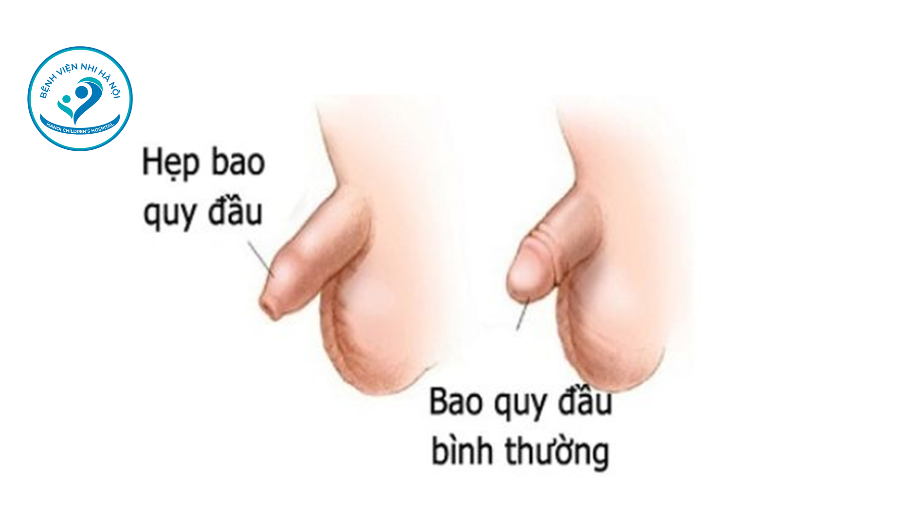 HẸP BAO QUY ĐẦU Ở TRẺ EM VÀ 4 CÁCH XỬ LY