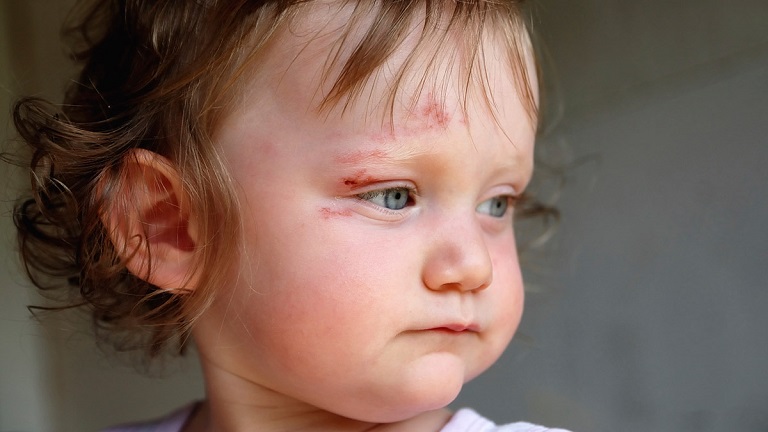 Điều Trị Nhiễm Trùng Tụ Cầu Khuẩn