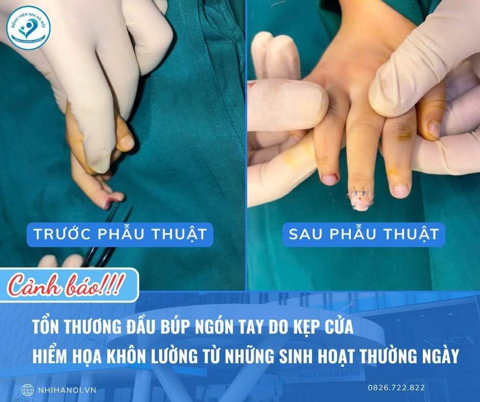 NGUY CƠ MẤT CẢM GIÁC ĐẦU NGÓN TAY DO TAI NẠN KÍNH CẮT VÀO TAY Ở TRẺ EM