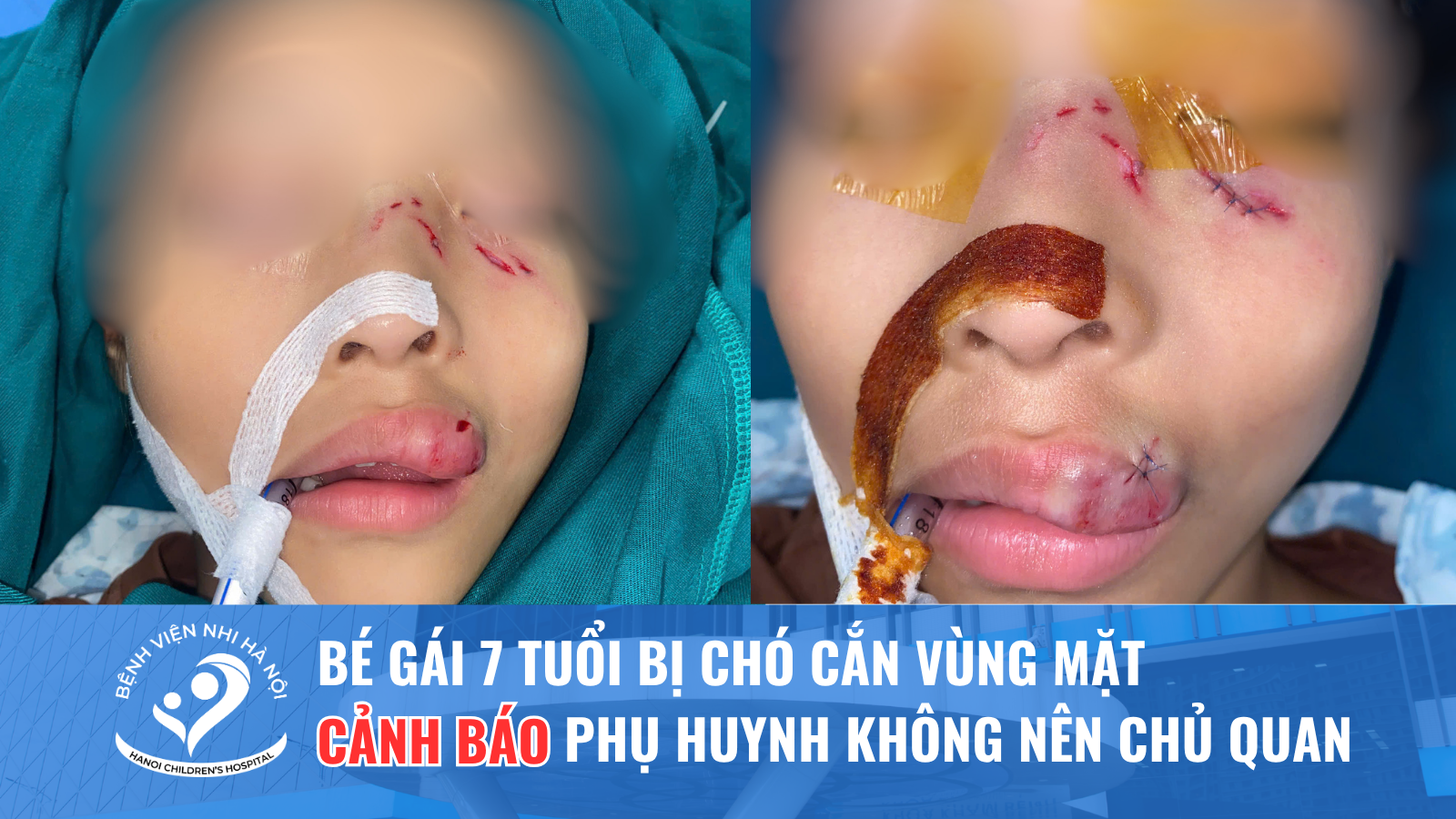 BÉ GÁI 7 TUỔI BỊ CHÓ CẮN VÙNG MẶT – CẢNH BÁO KHÔNG CHỦ QUAN VỚI NHỮNG VẾT THƯƠNG NHỎ