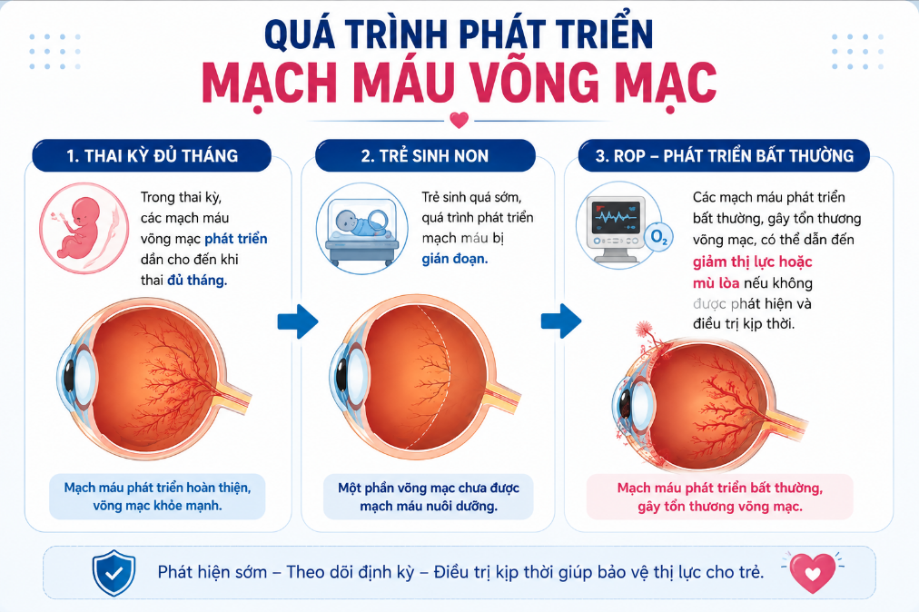 BỆNH VÕNG MẠC TRẺ SINH NON (ROP): 4 ĐIỀU CẦN BIẾT