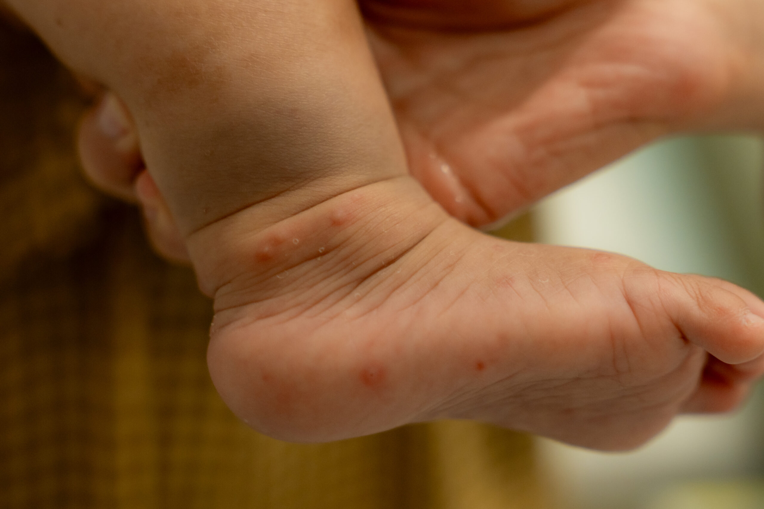 5 ĐIỀU CHA MẸ CẦN BIẾT VỀ BỆNH TAY CHÂN MIỆNG Ở TRẺ EM: CẢNH GIÁC NGUY CƠ CHUYỂN NẶNG NHANH
