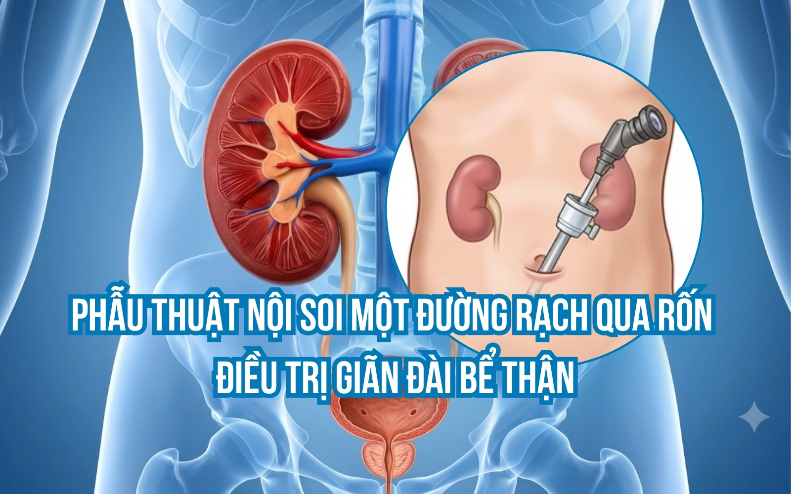 PHẪU THUẬT NỘI SOI 1 ĐƯỜNG RẠCH QUA RỐN ĐIỀU TRỊ GIÃN ĐÀI BỂ THẬN Ở TRẺ EM